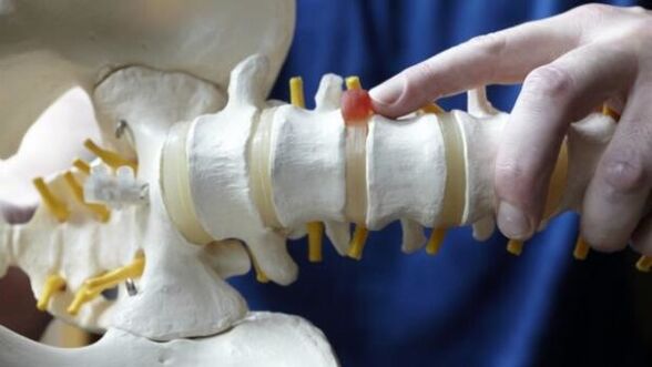 hernia espinal como causa de dolor de espalda
