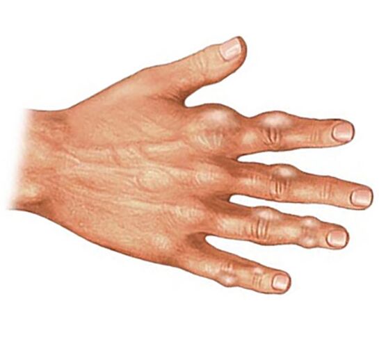 Deposición de cristales de ácido úrico en los tejidos blandos de los dedos con artritis gotosa