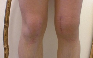 etapas de desarrollo de la artrosis de rodilla