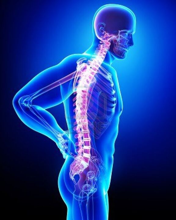 Columna vertebral humana afectada por osteocondrosis
