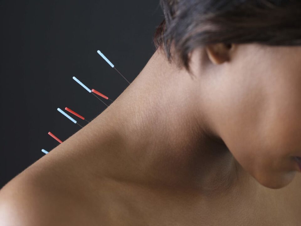 La acupuntura para la osteocondrosis cervical elimina los procesos inflamatorios. 