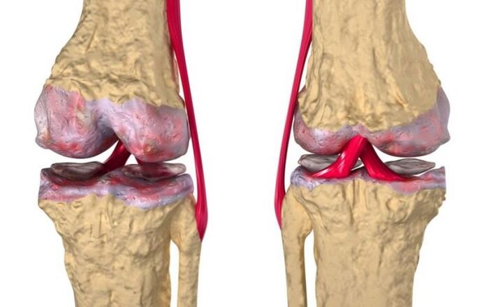 Artrosis de la articulación de la rodilla