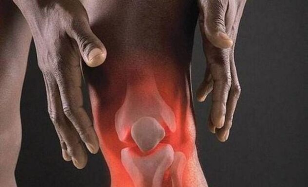 La artrosis se acompaña de un proceso inflamatorio en la articulación de la rodilla. 