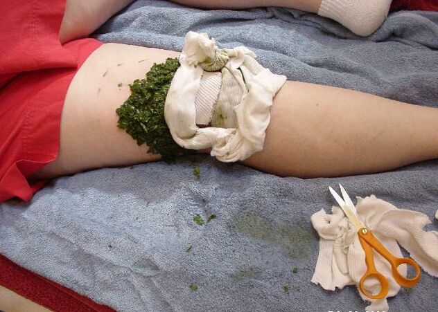 Una compresa caliente de hojas de col trituradas en una articulación de la rodilla dolorida con artrosis